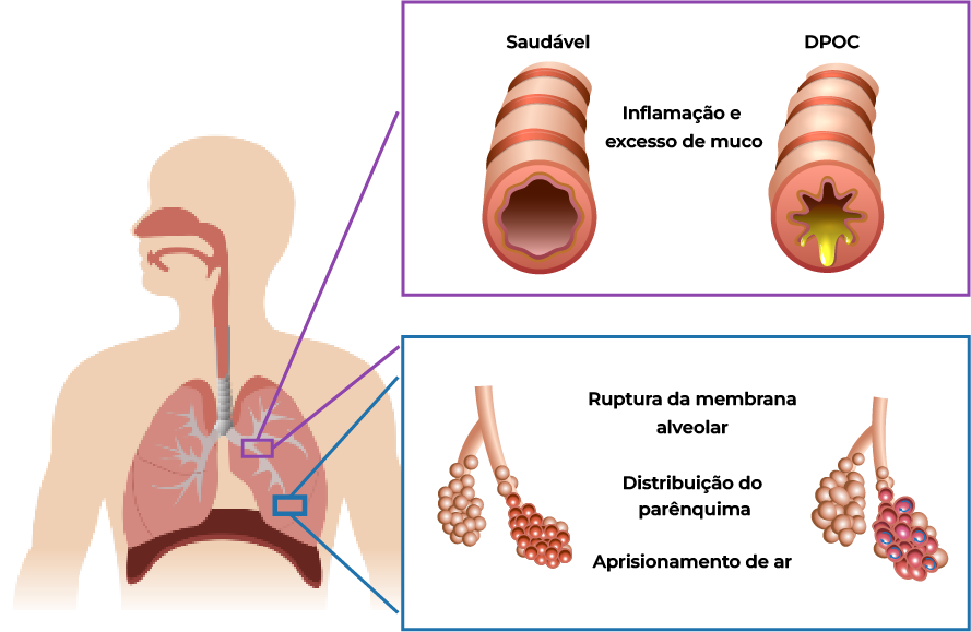 inflamação crônica