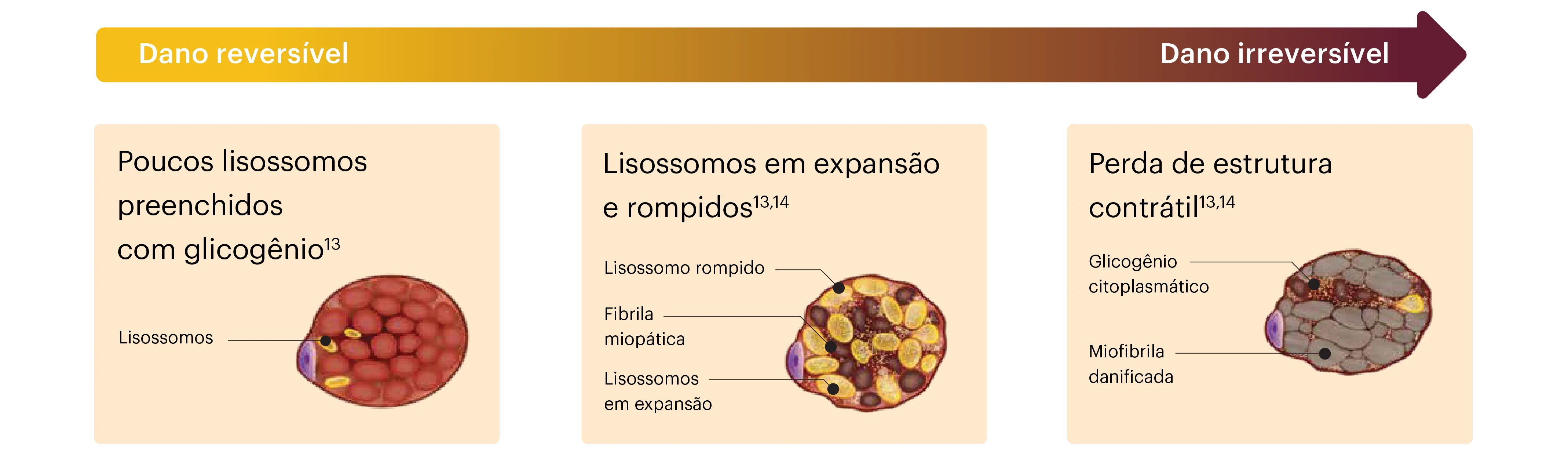 imagem explicativa sobre os danos da doença de Pompe